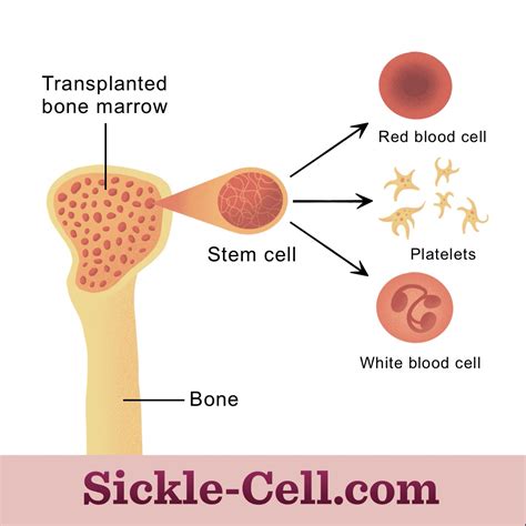 Bone Marrow Transplants for Sickle Cell Disease