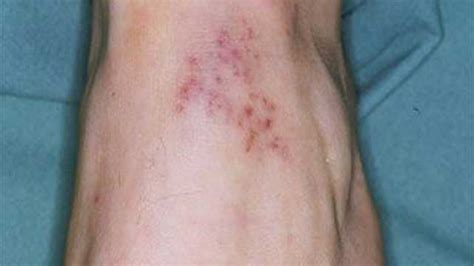 Bacterial Meningitis Skin Rash Adults