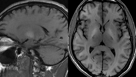 Dr Balaji Anvekar FRCR: Hepatic Encephalopathy MRI