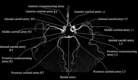 Radiology Anatomy Images : Anterior communicating artery Anterior ...