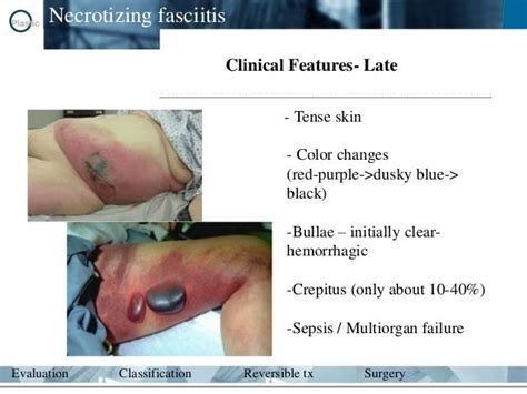 Necrotizing fasciitis and velopharyngeal aplasia by dr.damodhar.m.v