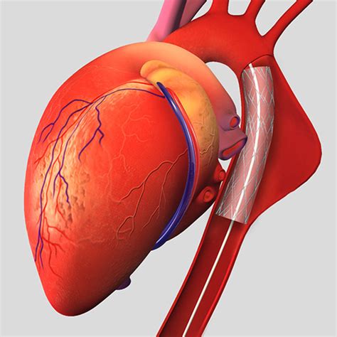 Thoracic Aortic Aneurysm Sydney | Endovascular Aneurysm Repair Sydney