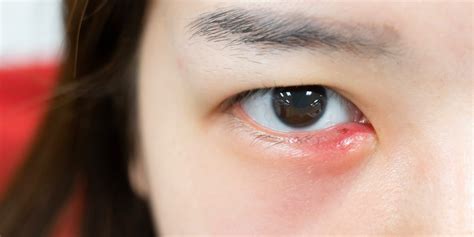 All About Eye Styes-Stye Causes, Treatment and Prevention - Dr. Jiwani ...