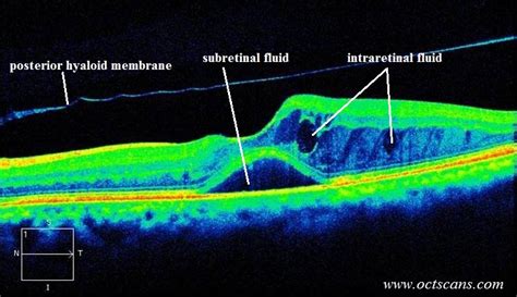 Diabetic macular edema (DME, CSME) - Optical Coherence Tomography Scans