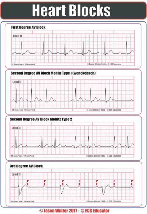 Complete Guide To Ecg Pdf