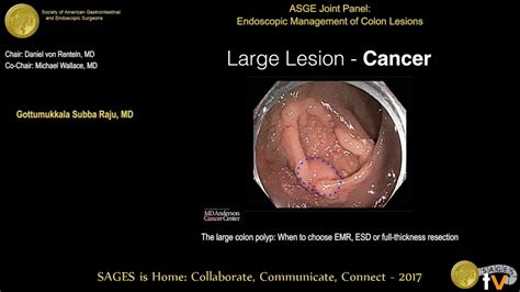 Large Colon Polyps