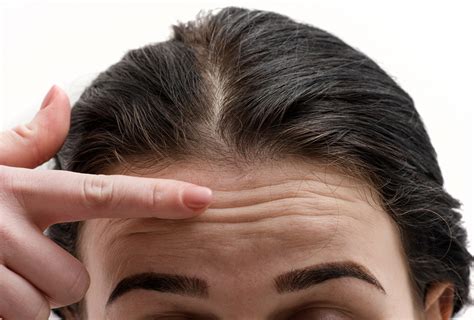 Possible Reasons for Forehead Wrinkles & Treatment Options