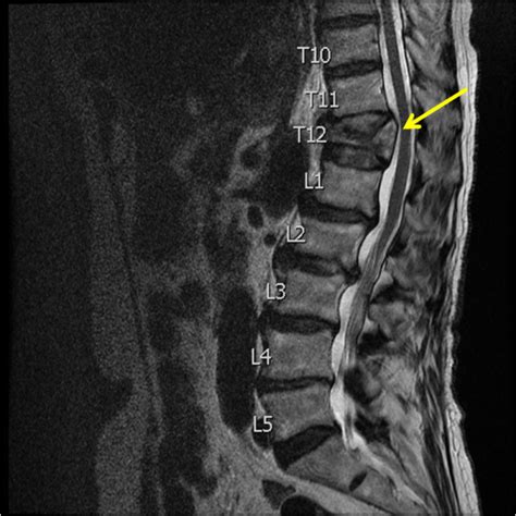 T7 Compression Fracture