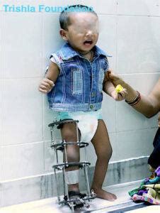 Spastic Hemiplegia Cerebral Palsy - Causes, Symptoms and Treatment ...