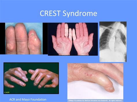 Systemic sclerosis