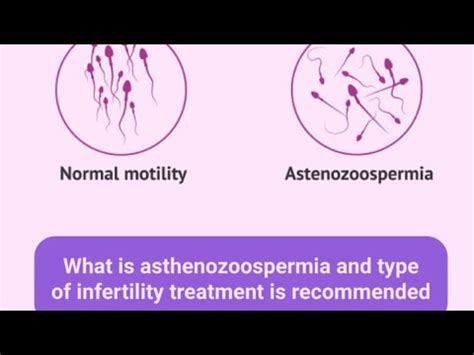 asthenozoospermia کا علاج/ What is asthenozoospermia/ causes and ...