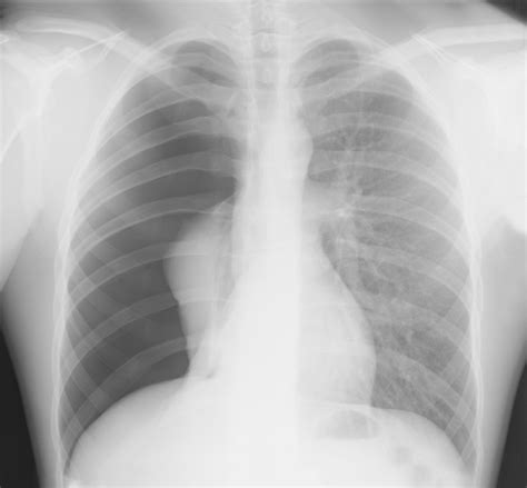 Spontaneous Pneumothorax Hospital Admissions Have Increased ...