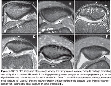 mri chondromalacia | Chondromalacia Patellae Mri | Chondromalacia ...