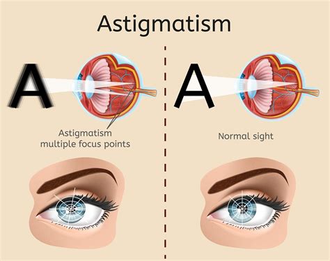 Lasik Eye Surgery Cost for Astigmatism | Excel Eye