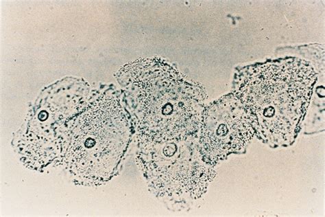 Gardnerella vaginalis - Microbiology - Medbullets Step 1