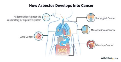 What Types of Cancers Are Caused by Asbestos?