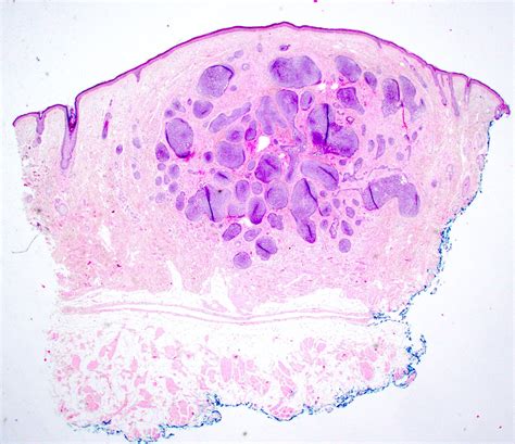 Trichoadenoma Histology