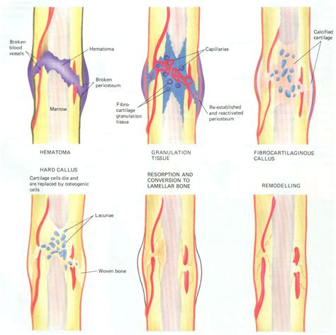 Healing of a bone fracture | Medical knowledge, Nurse teaching, Nursing ...