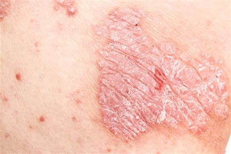 Psoriasis: Causes, Types and Treatment - Dermatological Society of ...