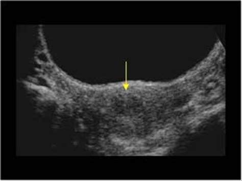 Gynaecology | 3.1 Uterus : Case 3.1.1 Uterine fibroids | Ultrasound Cases