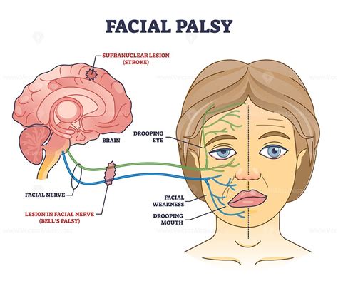 Facial palsy and muscles weakness because of nerve damage outline ...