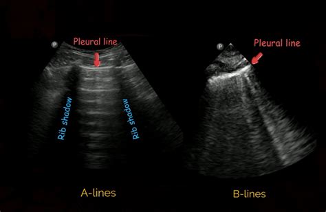 Lung Ultrasound Colligo Academy