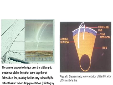 Gonioscopy presentation | PPT