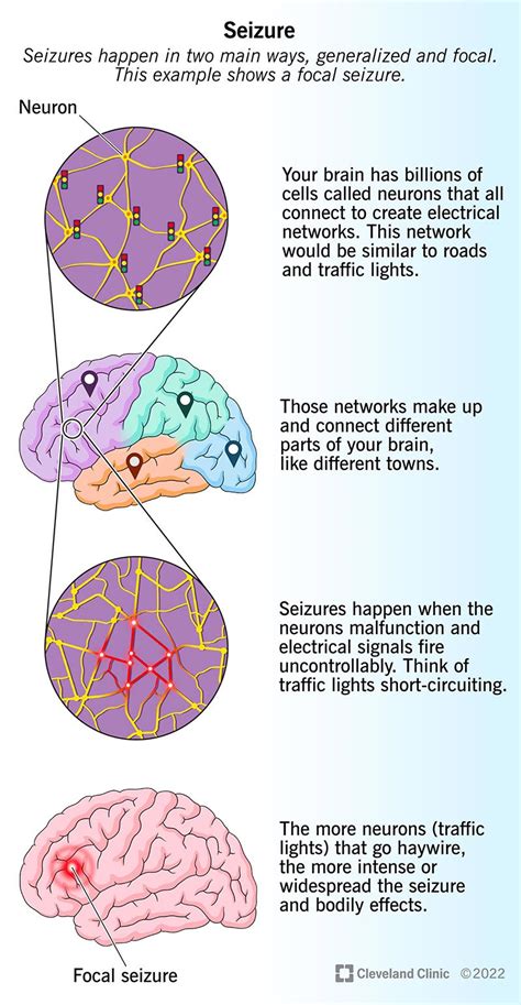 Top 7 what are 5 common causes of seizures 2022