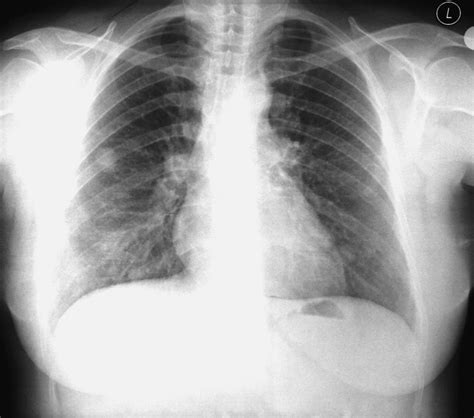 Benign Metastasizing Leiomyoma Presenting as Cavitating Lung Nodules ...