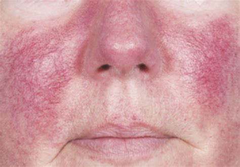 Rosacea Symptoms & Treatment Options | Lauren Erro