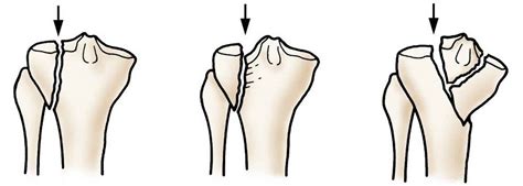 Tibial plateau fracture causes, types, symptoms, diagnosis & treatment