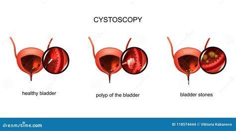 Cystoscopy of the Bladder. Stones and Polyp. Stock Vector ...