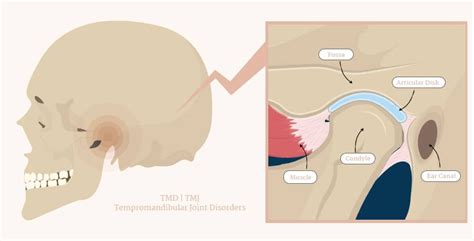 Feeling Jaw Pain? Learn About TMD Disorder & Exercises For Pain Relief ...