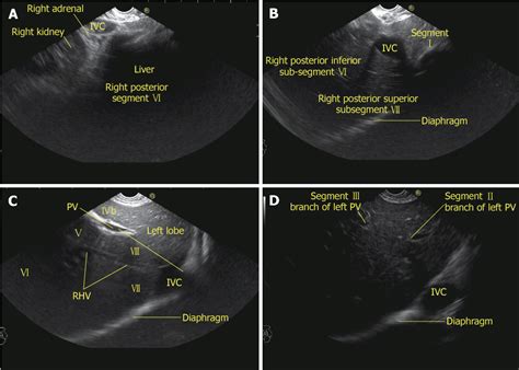 Liver Segment 7 Ultrasound