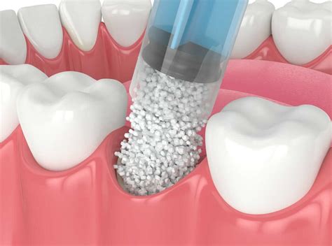 Dental Bone Graft - Bone Graft for Dental Implant