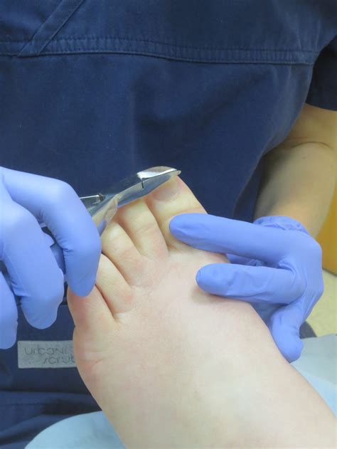 Nail care and toenail cutting | Total Foot Health