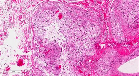 Mucocele Histology