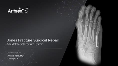 5th metatarsal fracture - virtweare