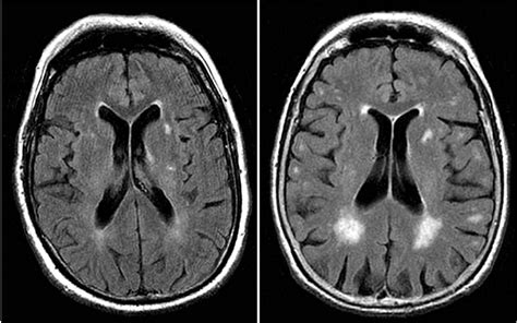 Health Information Guides: Brain MRI White Matter Intensities: Clinical ...