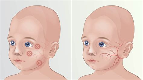 Increasing Occurrences of Phenylketonuria to drive the Phenylketonuria ...