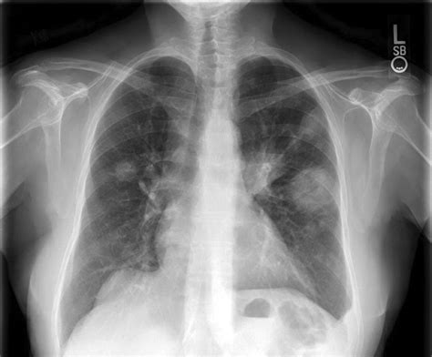 53 A 57-Year-Old Female With Cavitary Lung Lesions | Basicmedical Key