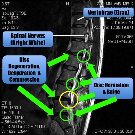 Lower Back Injury Prognosis Update | How Do I Get Ripped?