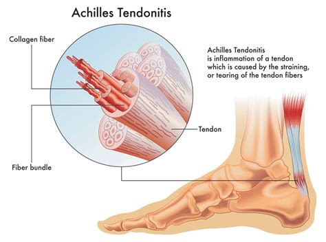 Achilles Tendon Pain - Causes, Treatments & Prevention