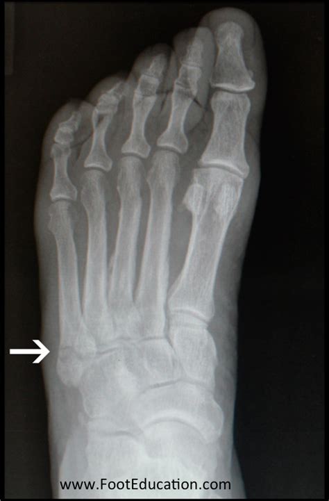 5th Metatarsal Avulsion Fracture - FootEducation