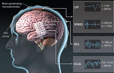 Translating the Brain-Machine Interface | Science Translational Medicine