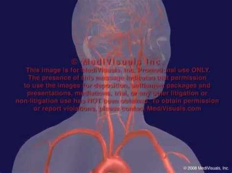 Vertebral Artery Occlusion - YouTube