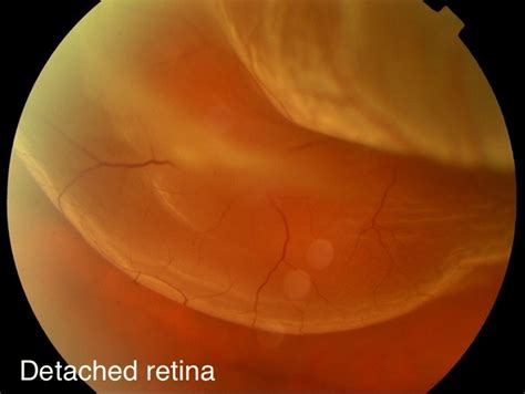 Retinal Detachment | Symptoms | Causes | Risks | Treatments