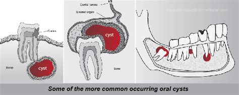 Cyst Removal – Mediatrix