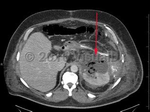 Perinephric abscess