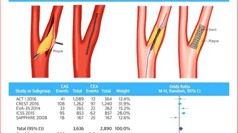 Carotid Endarterectomy Procedure Steps